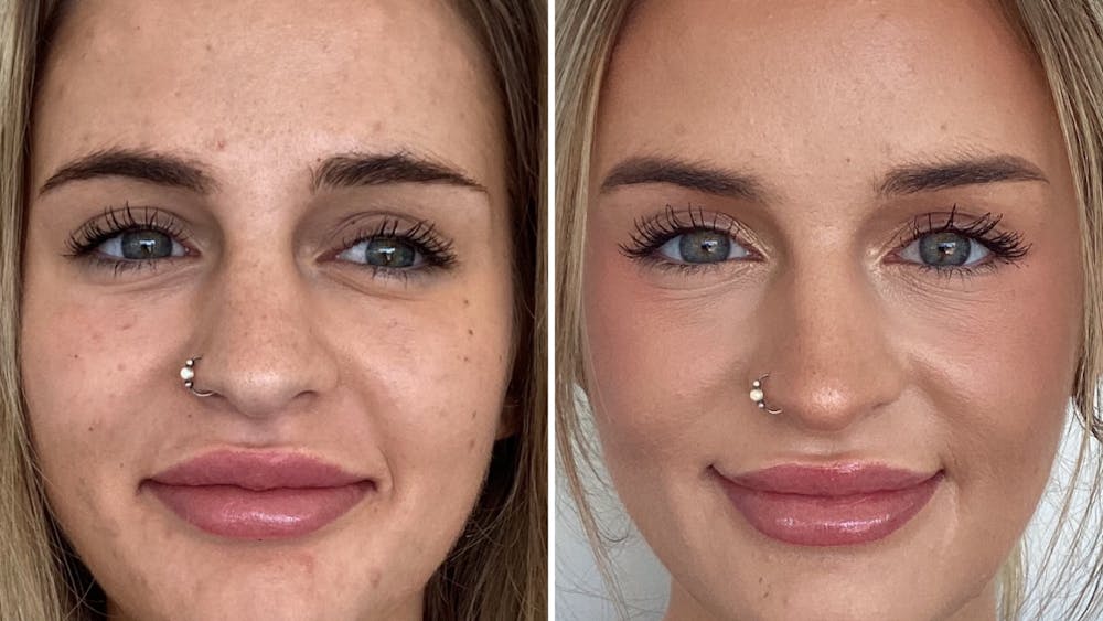BOTOX/Daxxify Before & After Gallery - Patient 106004 - Image 1