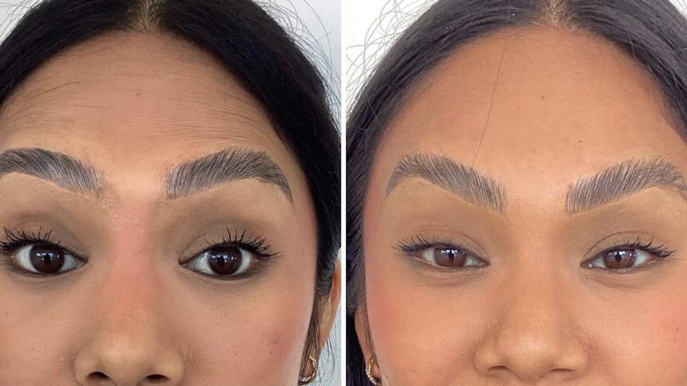 BOTOX/Daxxify Before & After Gallery - Patient 814690 - Image 2