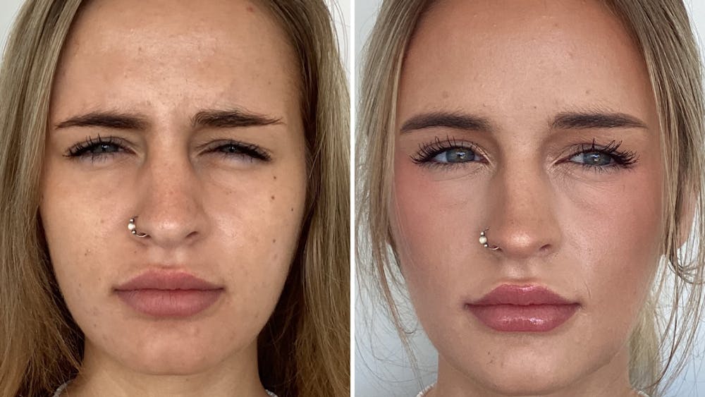 BOTOX/Daxxify Before & After Gallery - Patient 106004 - Image 2