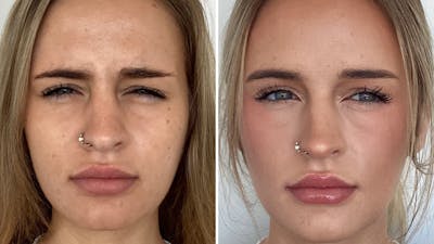BOTOX/Daxxify Before & After Gallery - Patient 106004 - Image 2