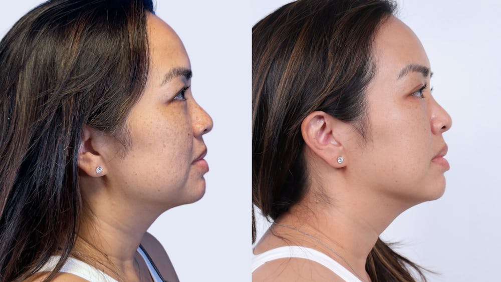 Kybella Before & After Gallery - Patient 382026 - Image 1
