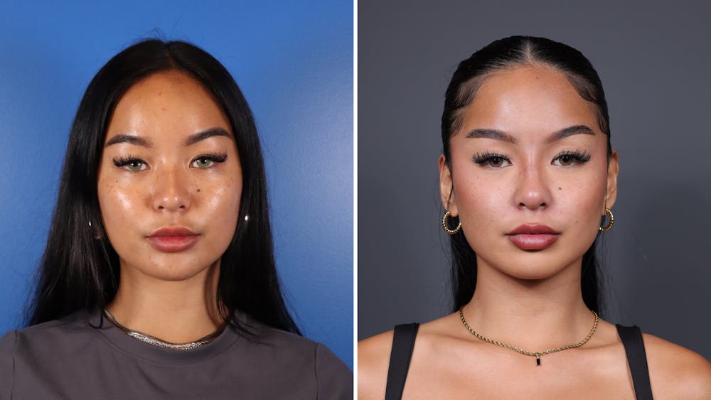 Chemical Peels Before & After Gallery - Patient 204187 - Image 1