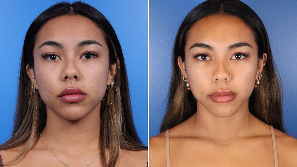 Chemical Peels Before & After Gallery - Patient 256274 - Image 1
