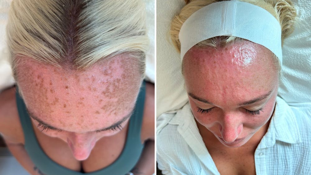 Chemical Peels Before & After Gallery - Patient 137172 - Image 1