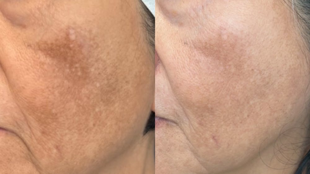 Chemical Peels Before & After Gallery - Patient 312907 - Image 1