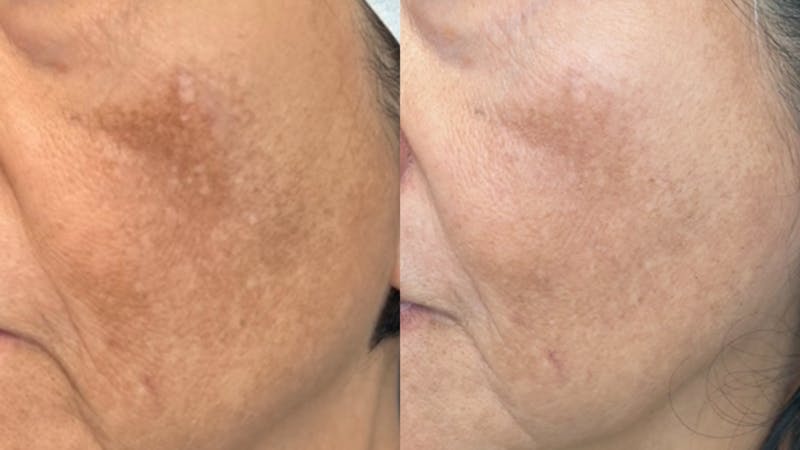 chemical peels before & after