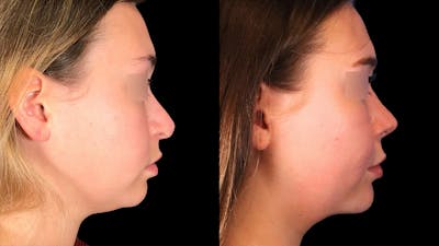 Rhinoplasty Before & After Gallery - Patient 333782 - Image 1