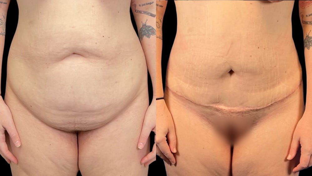 Tummy Tuck Before & After Gallery - Patient 38298986 - Image 1