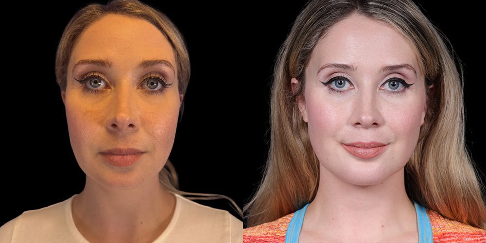 Chin Before & After Gallery - Patient 212638 - Image 3