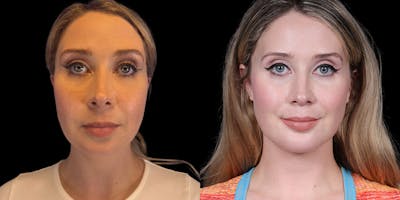 Laser Liposuction Before & After Gallery - Patient 351811 - Image 1