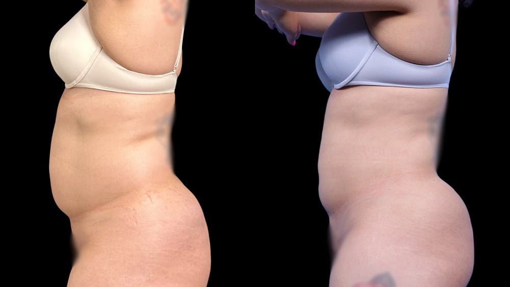 Laser Liposuction Before & After Gallery - Patient 111580 - Image 3
