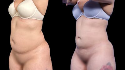 Laser Liposuction Before & After Gallery - Patient 111580 - Image 2