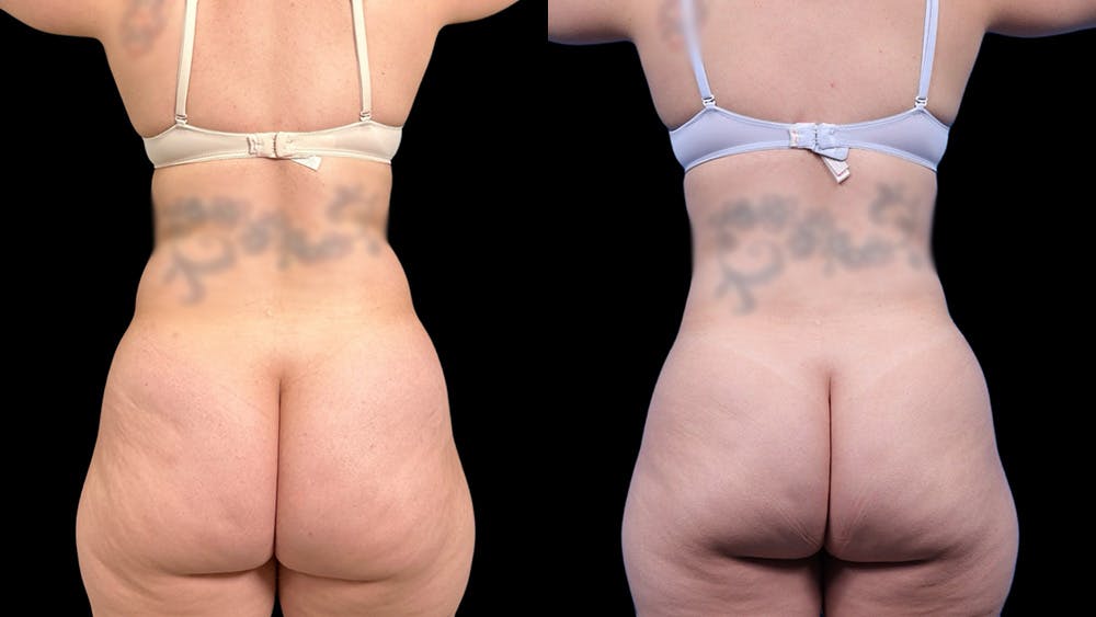 Laser Liposuction Before & After Gallery - Patient 111580 - Image 5