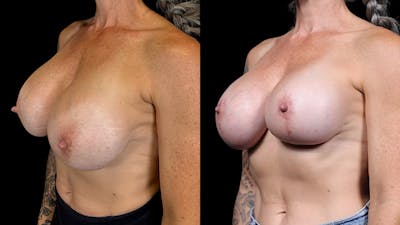 Breast Augmentation Revision Before & After Gallery - Patient 801294 - Image 2