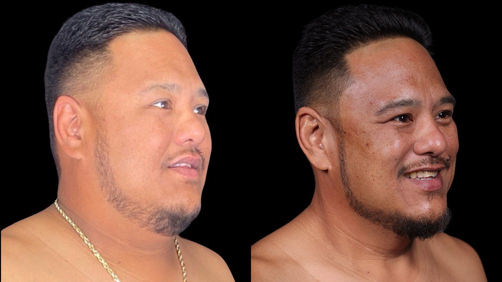 Semaglutide Before & After Gallery - Patient 199678 - Image 7