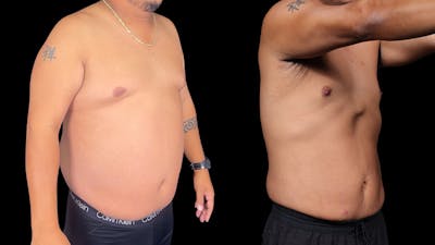 Semaglutide Before & After Gallery - Patient 199678 - Image 2