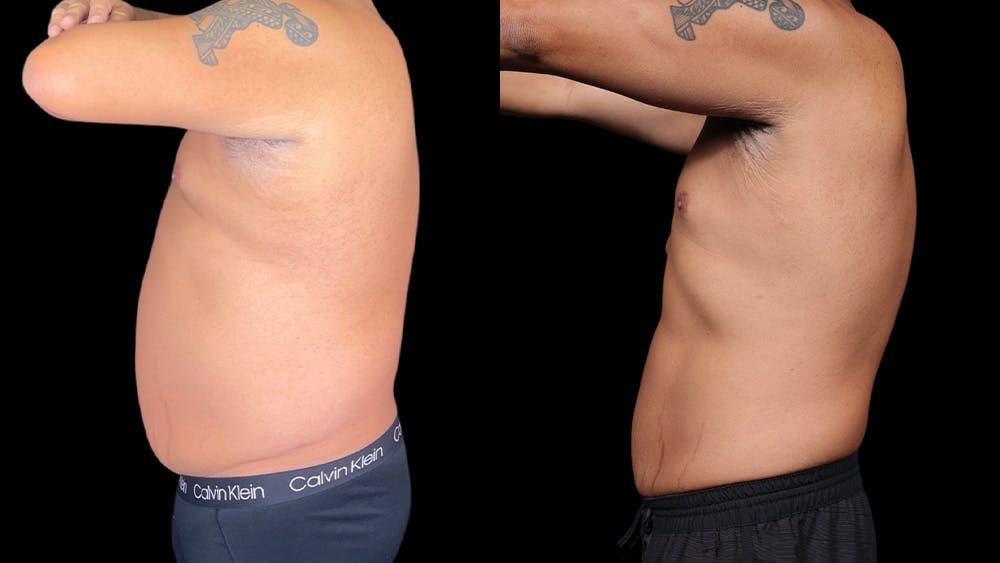 Semaglutide Before & After Gallery - Patient 199678 - Image 4