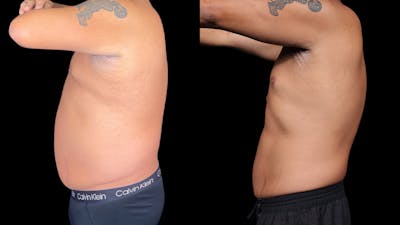 Semaglutide Before & After Gallery - Patient 199678 - Image 4