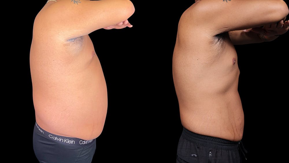 Semaglutide Before & After Gallery - Patient 199678 - Image 3