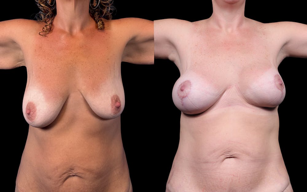 Breast Lift with Implants Before & After Gallery - Patient 38290664 - Image 2