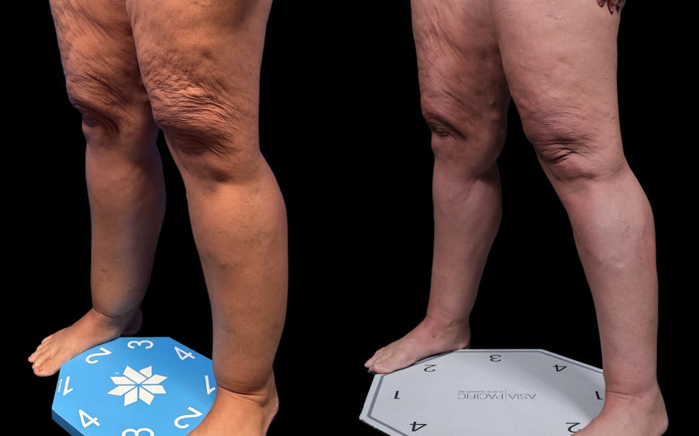 Laser Liposuction Before & After Gallery - Patient 240415 - Image 3