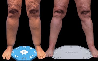 Laser Liposuction Before & After Gallery - Patient 240415 - Image 1