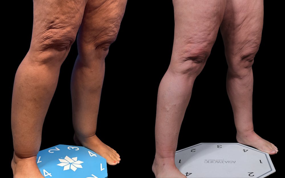 Laser Liposuction Before & After Gallery - Patient 240415 - Image 2