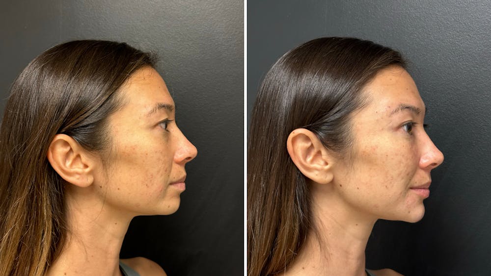 Dermal Fillers Before & After Gallery - Patient 993803 - Image 2