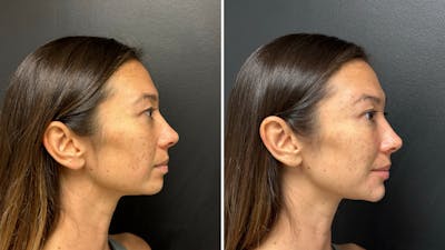 Dermal Fillers Before & After Gallery - Patient 993803 - Image 2