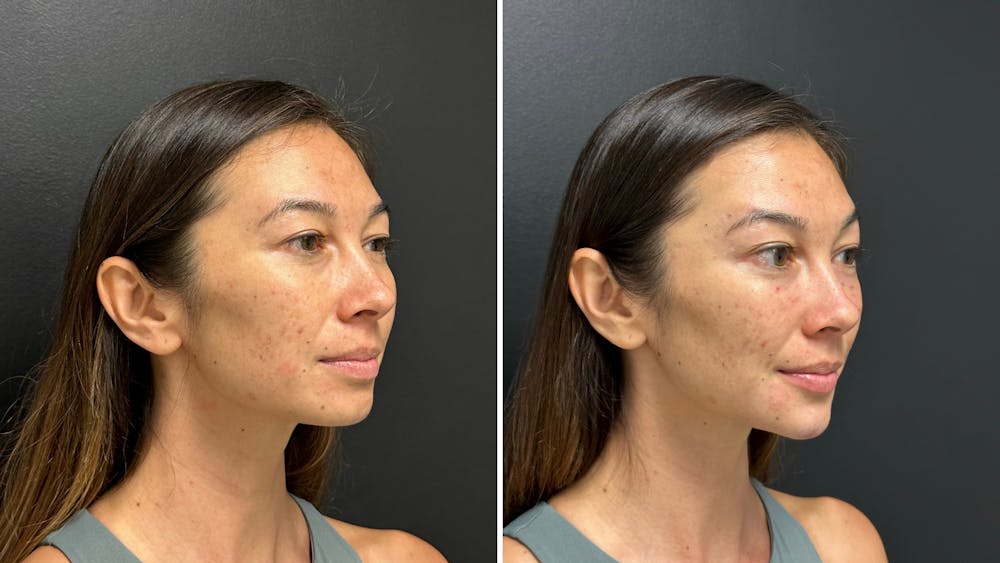 Dermal Fillers Before & After Gallery - Patient 993803 - Image 1