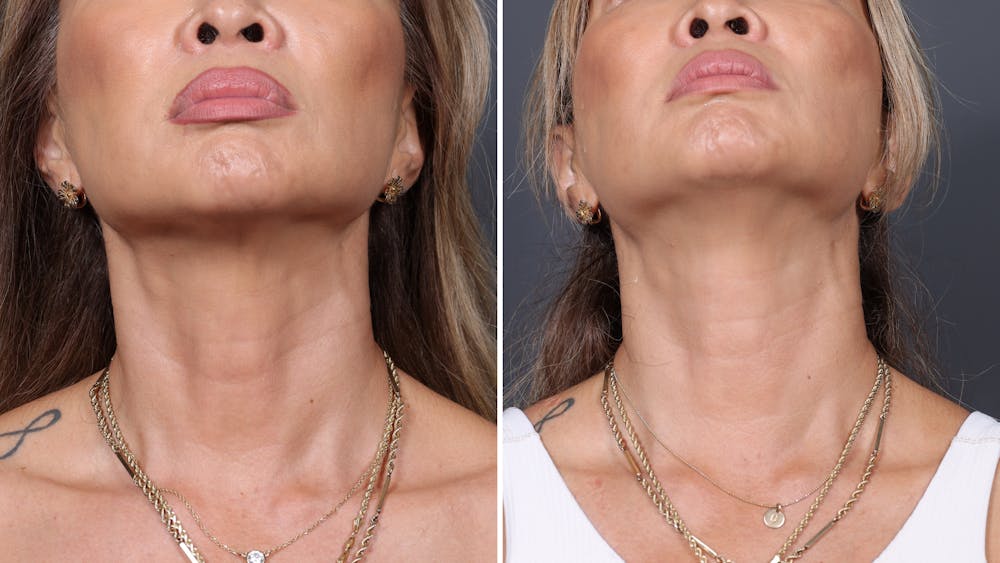 Dermal Fillers Before & After Gallery - Patient 308718 - Image 2