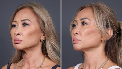 Dermal Fillers Before & After Gallery - Patient 308718 - Image 1