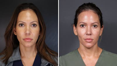 BOTOX/Daxxify Before & After Gallery - Patient 162891 - Image 1