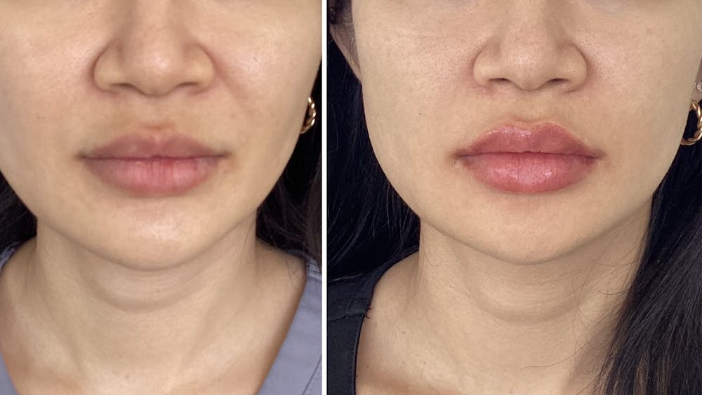Dermal Fillers Before & After Gallery - Patient 171517 - Image 1