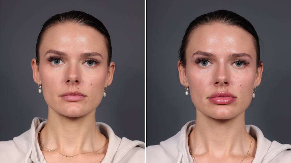 Dermal Fillers Before & After Gallery - Patient 307581 - Image 1