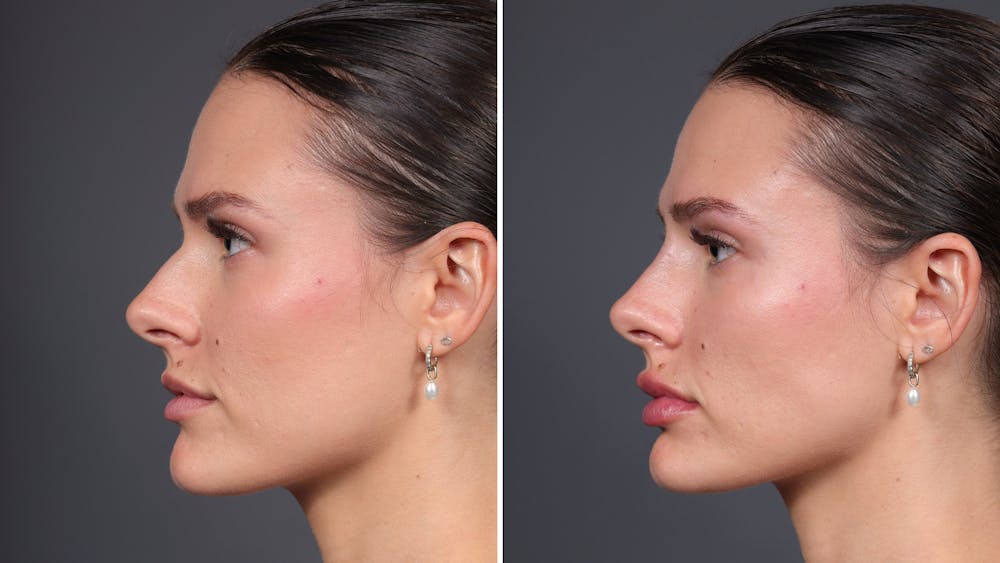 Dermal Fillers Before & After Gallery - Patient 307581 - Image 2