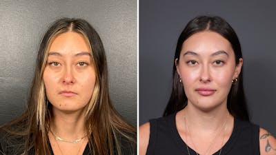 Facial Balancing Before & After Gallery - Patient 135709 - Image 1