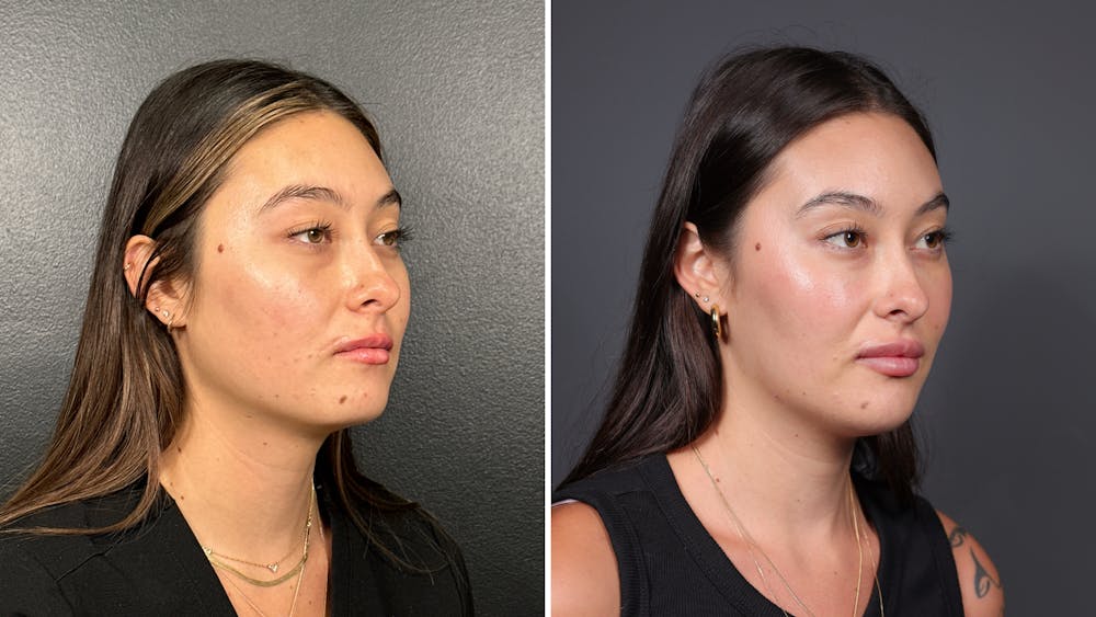 Dermal Fillers Before & After Gallery - Patient 155867 - Image 2