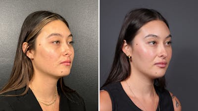 Dermal Fillers Before & After Gallery - Patient 155867 - Image 2