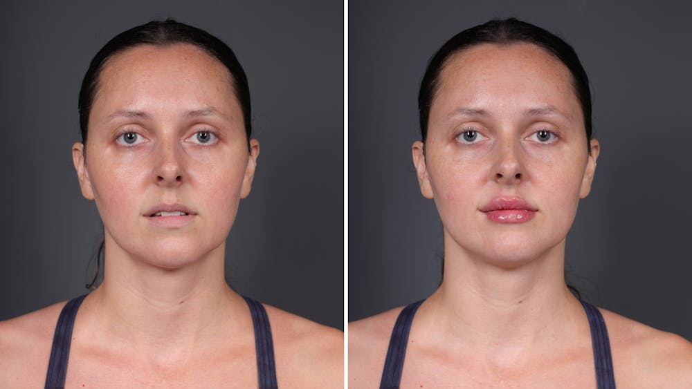 Dermal Fillers Before & After Gallery - Patient 921870 - Image 1