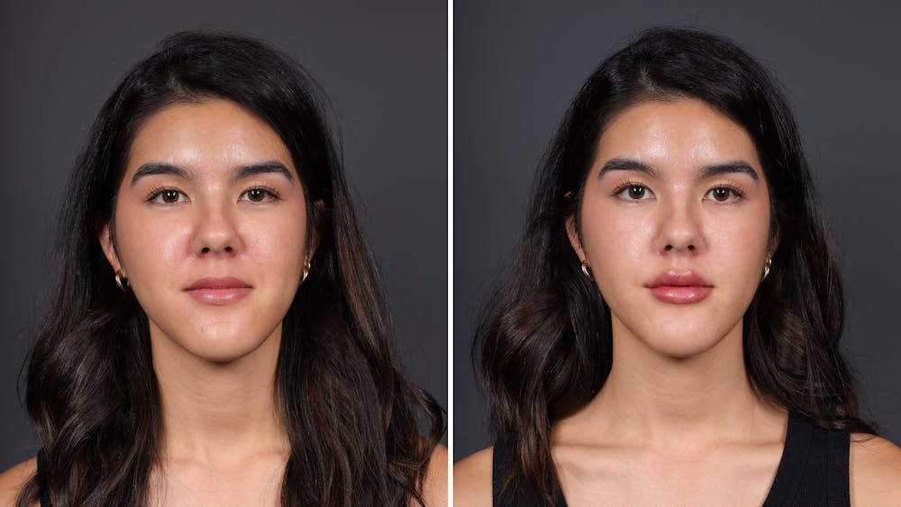 Dermal Fillers Before & After Gallery - Patient 223330 - Image 1