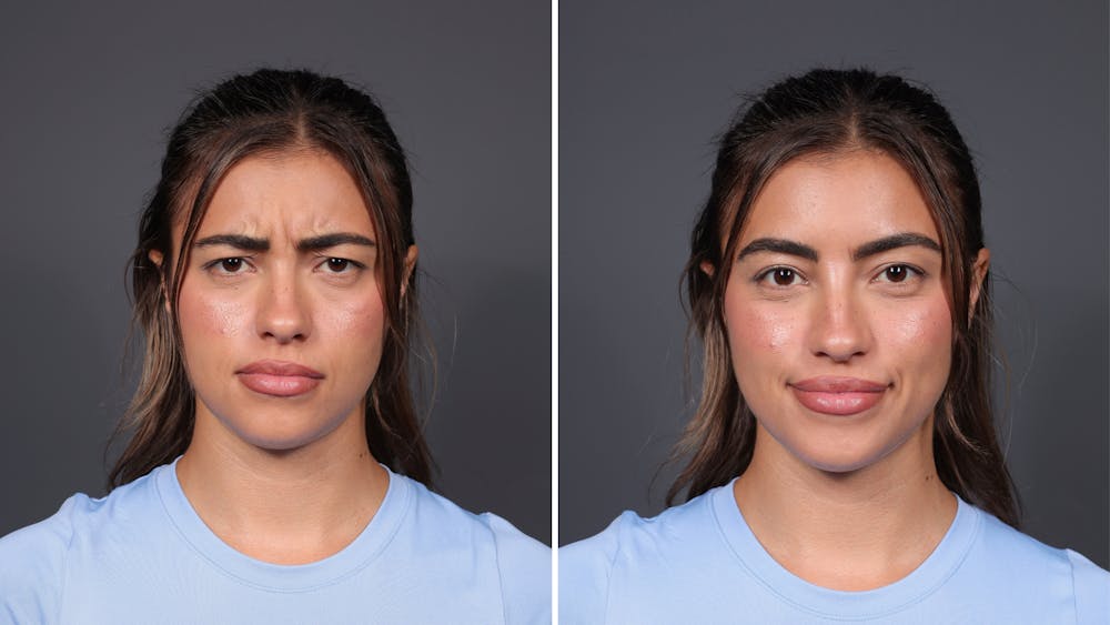 BOTOX/Daxxify Before & After Gallery - Patient 138429 - Image 1