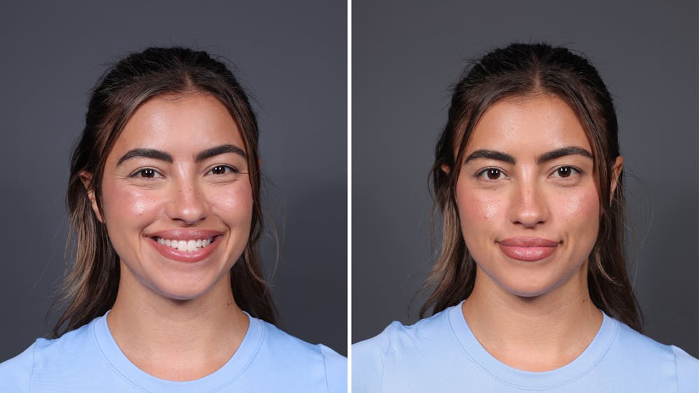 BOTOX/Daxxify Before & After Gallery - Patient 138429 - Image 2