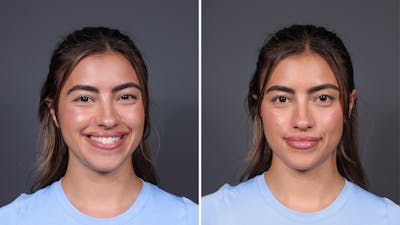 BOTOX/Daxxify Before & After Gallery - Patient 138429 - Image 2