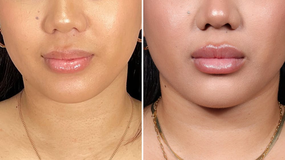 Dermal Fillers Before & After Gallery - Patient 400624 - Image 1