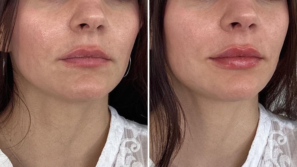 Dermal Fillers Before & After Gallery - Patient 690938 - Image 1