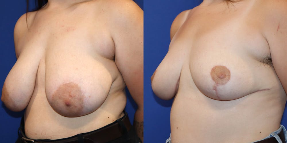 Breast Reduction Before & After Gallery - Patient 103107 - Image 4