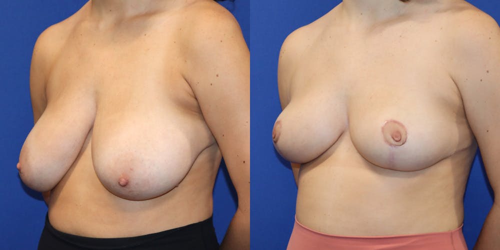 Breast Reduction Before & After Gallery - Patient 177777126 - Image 4