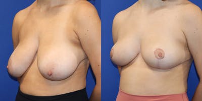 Breast Reduction Before & After Gallery - Patient 177777126 - Image 4