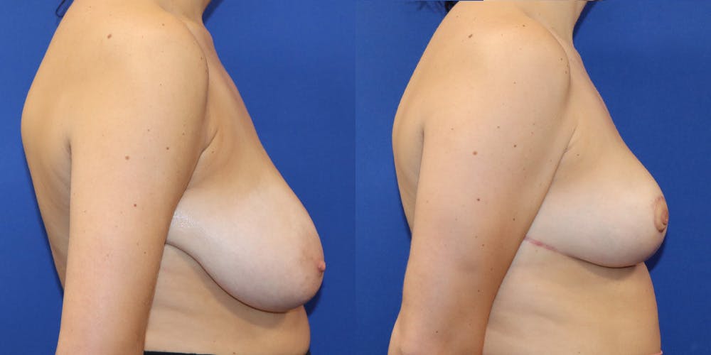 Breast Reduction Before & After Gallery - Patient 177777126 - Image 3